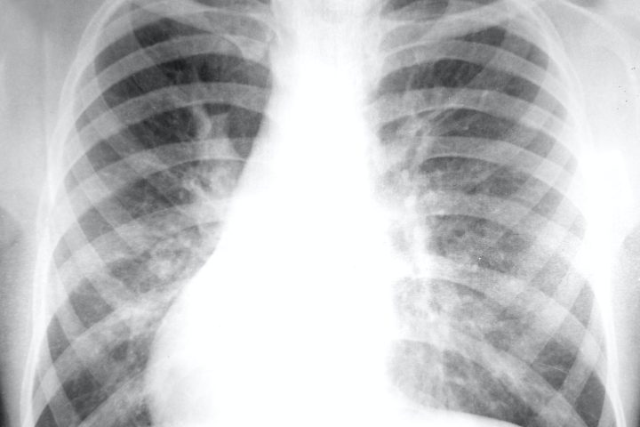 Chest X-ray